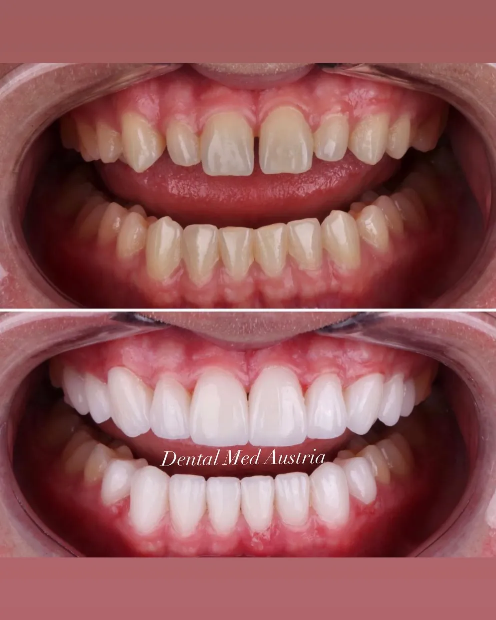 Couronnes Dentaires — Dental Med Austria