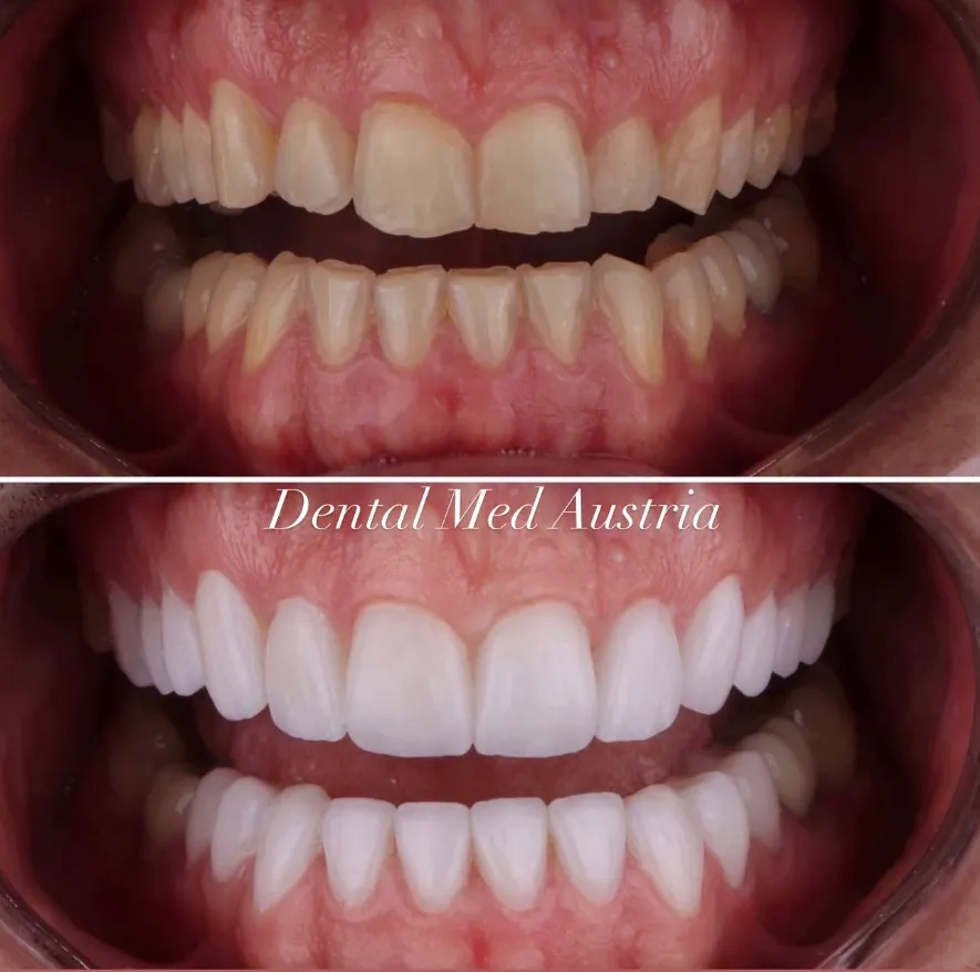 Couronnes Dentaires — Dental Med Austria