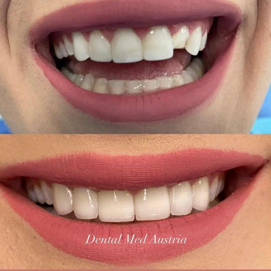 Couronnes Dentaires — Dental Med Austria