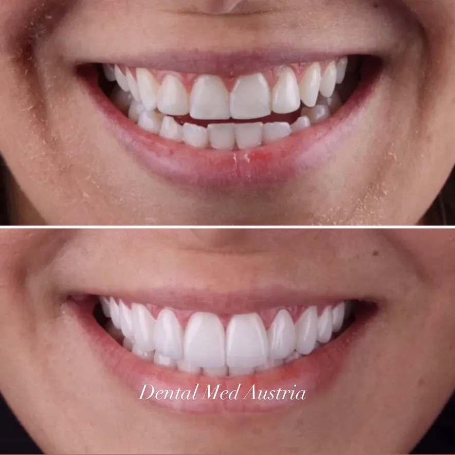 Couronnes Dentaires — Dental Med Austria