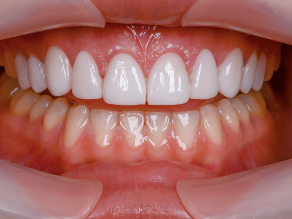 Couronnes Dentaires — VIP Smile