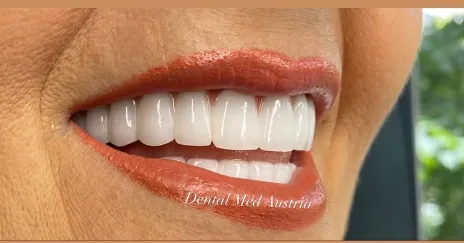 Couronnes Dentaires — Dental Med Austria