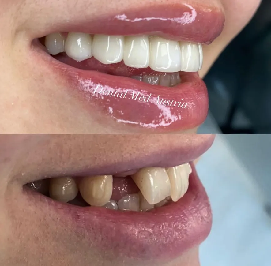 Couronnes Dentaires — Dental Med Austria