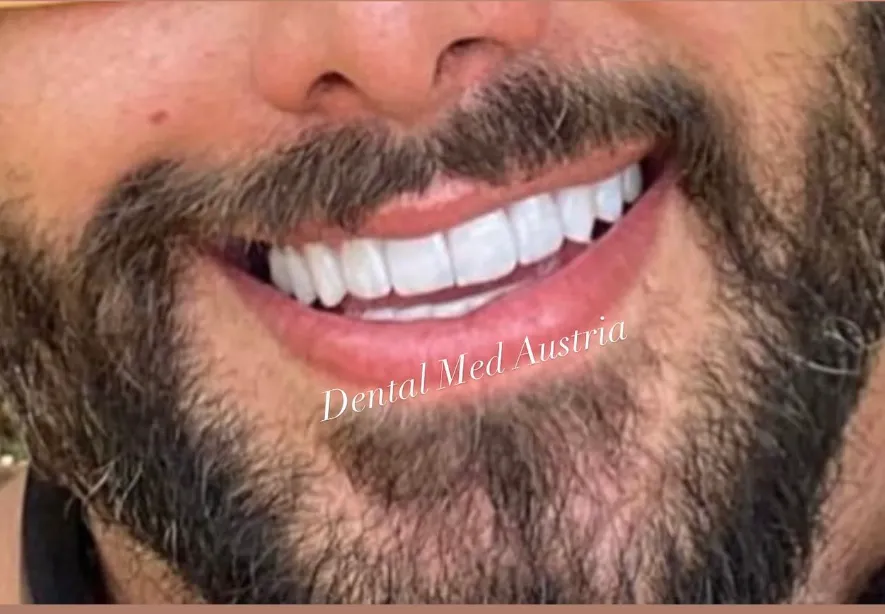 Couronnes Dentaires — Dental Med Austria