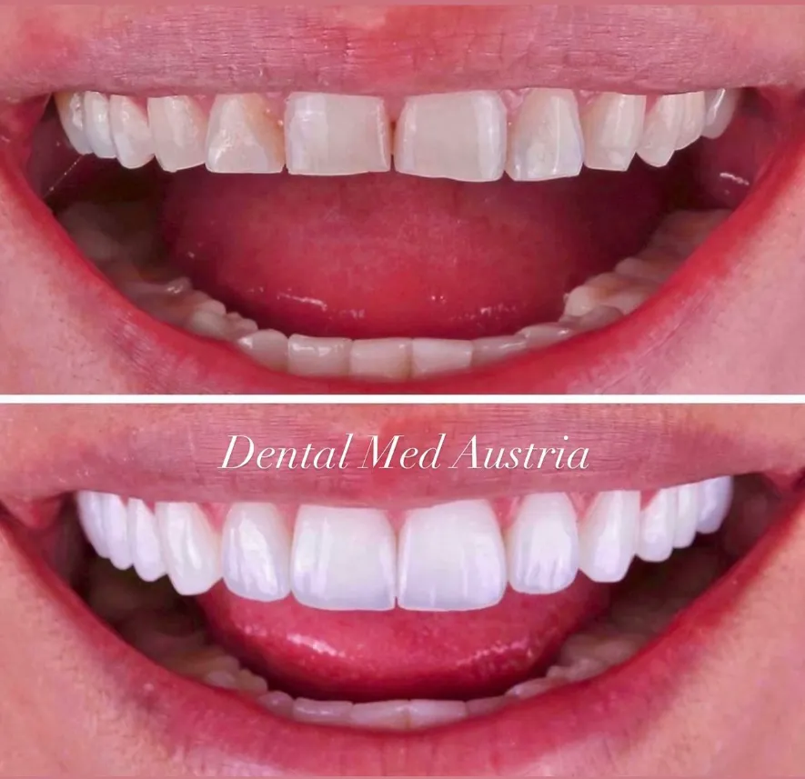 Couronnes Dentaires — Dental Med Austria