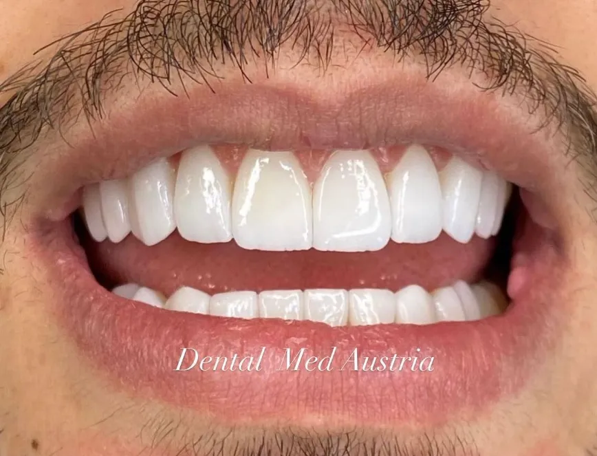 Couronnes Dentaires — Dental Med Austria