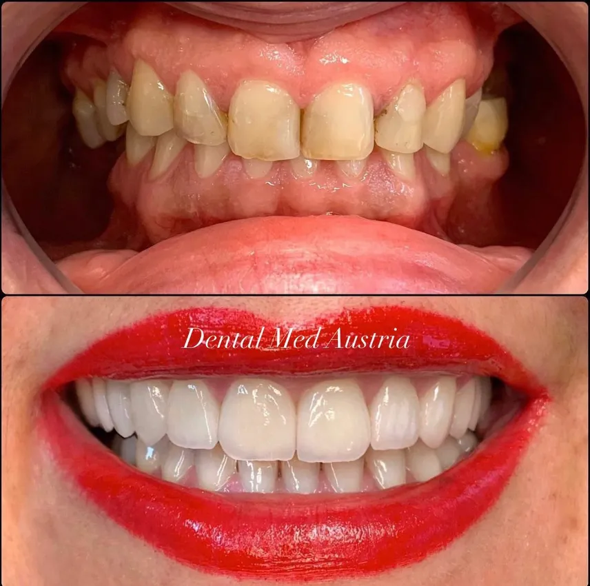 Couronnes Dentaires — Dental Med Austria