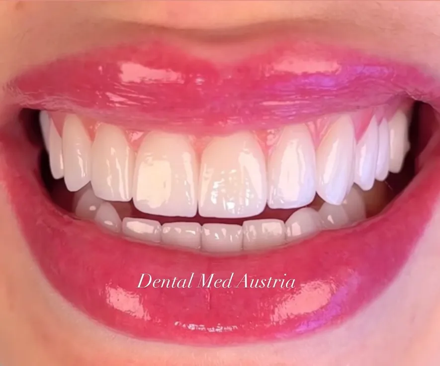 Couronnes Dentaires — Dental Med Austria