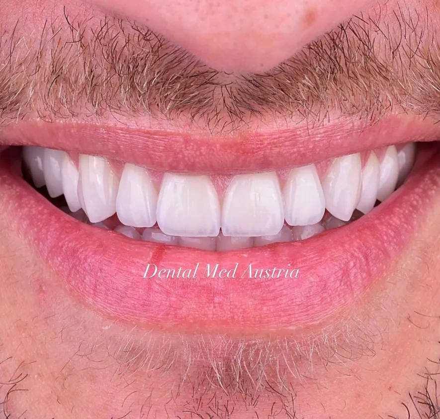 Couronnes Dentaires — Dental Med Austria