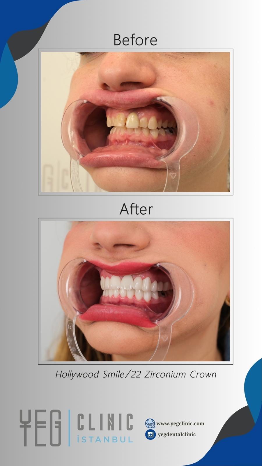 Couronnes Zircones — Yeg clinic