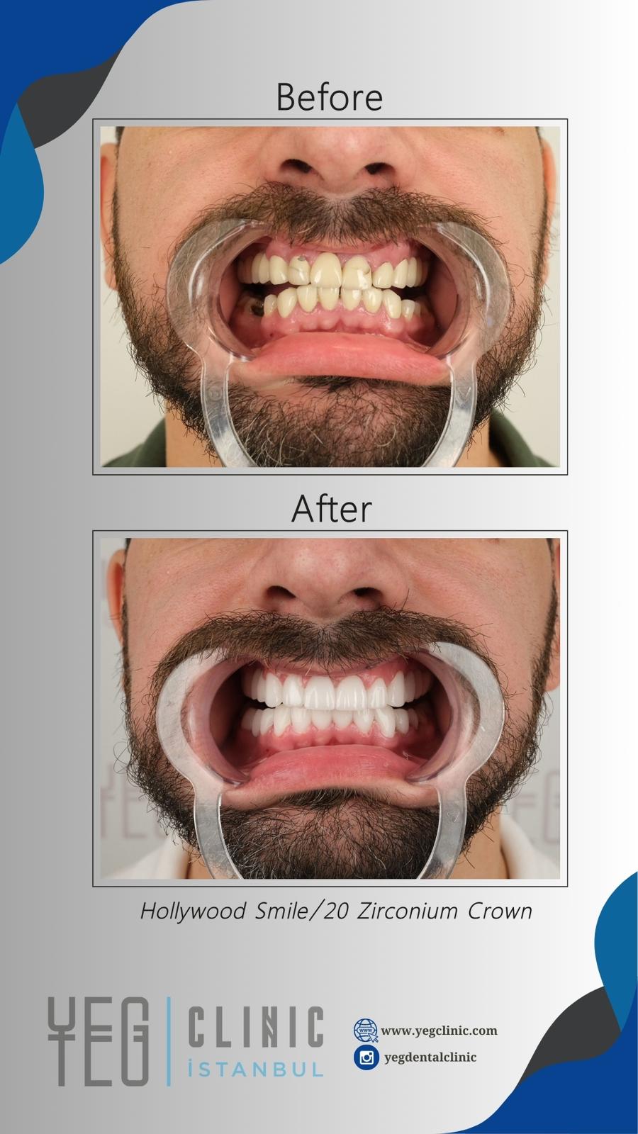 Couronnes Zircones — Yeg clinic