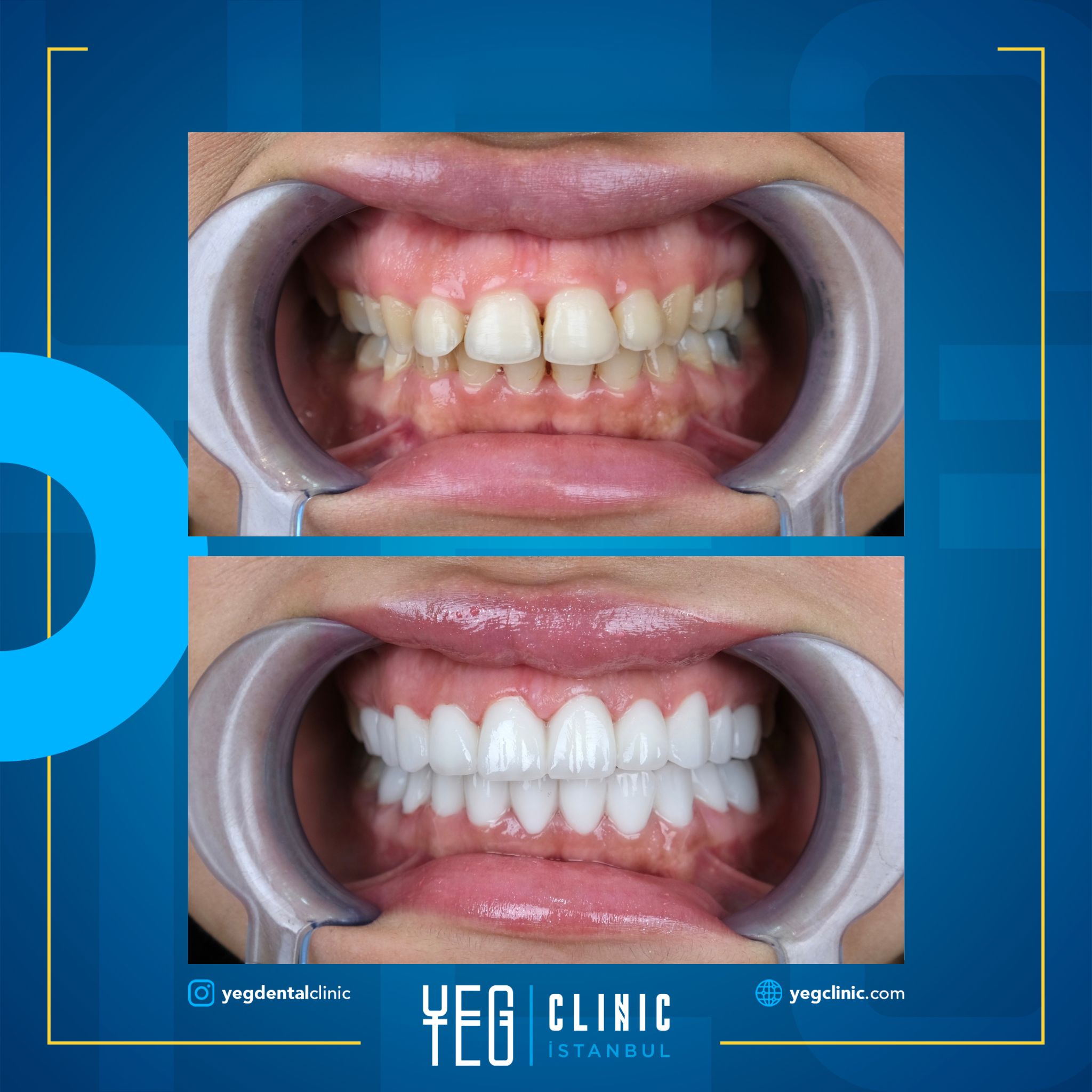 Couronnes Zircones — Yeg clinic