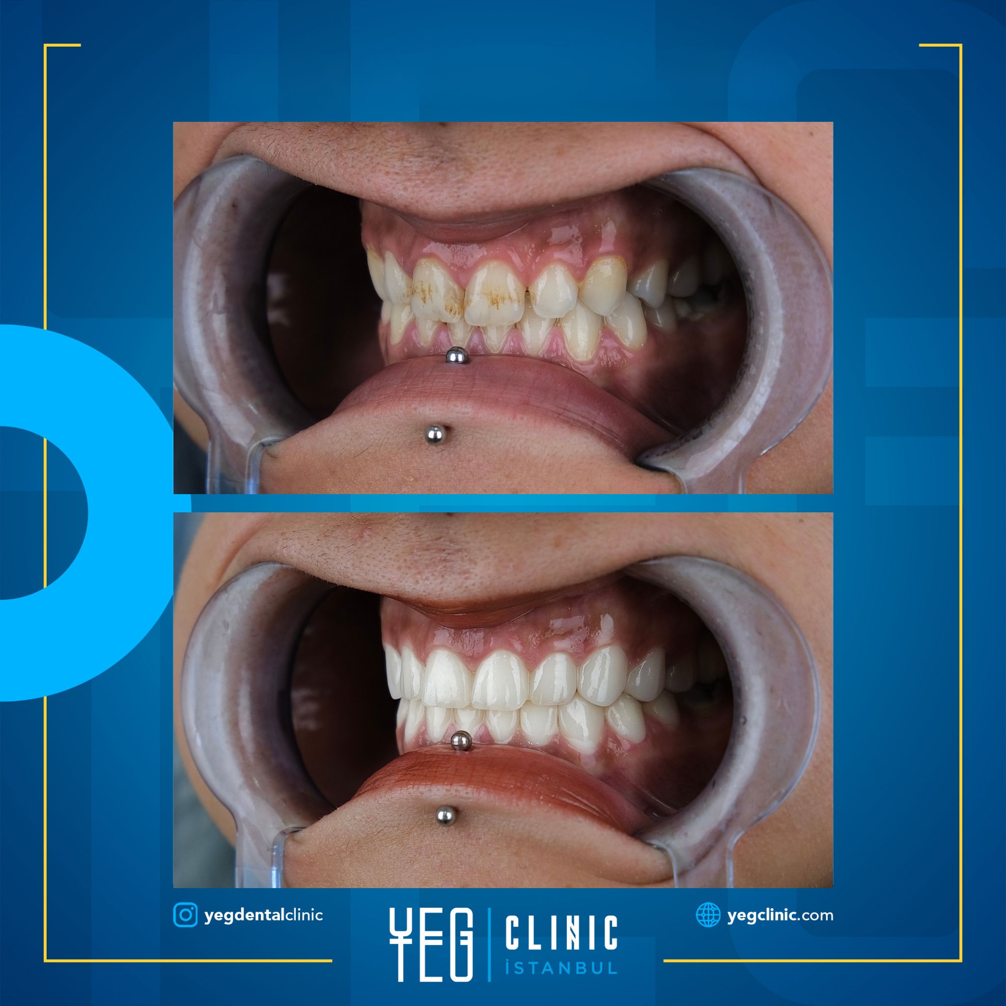 Couronnes Zircones — Yeg clinic