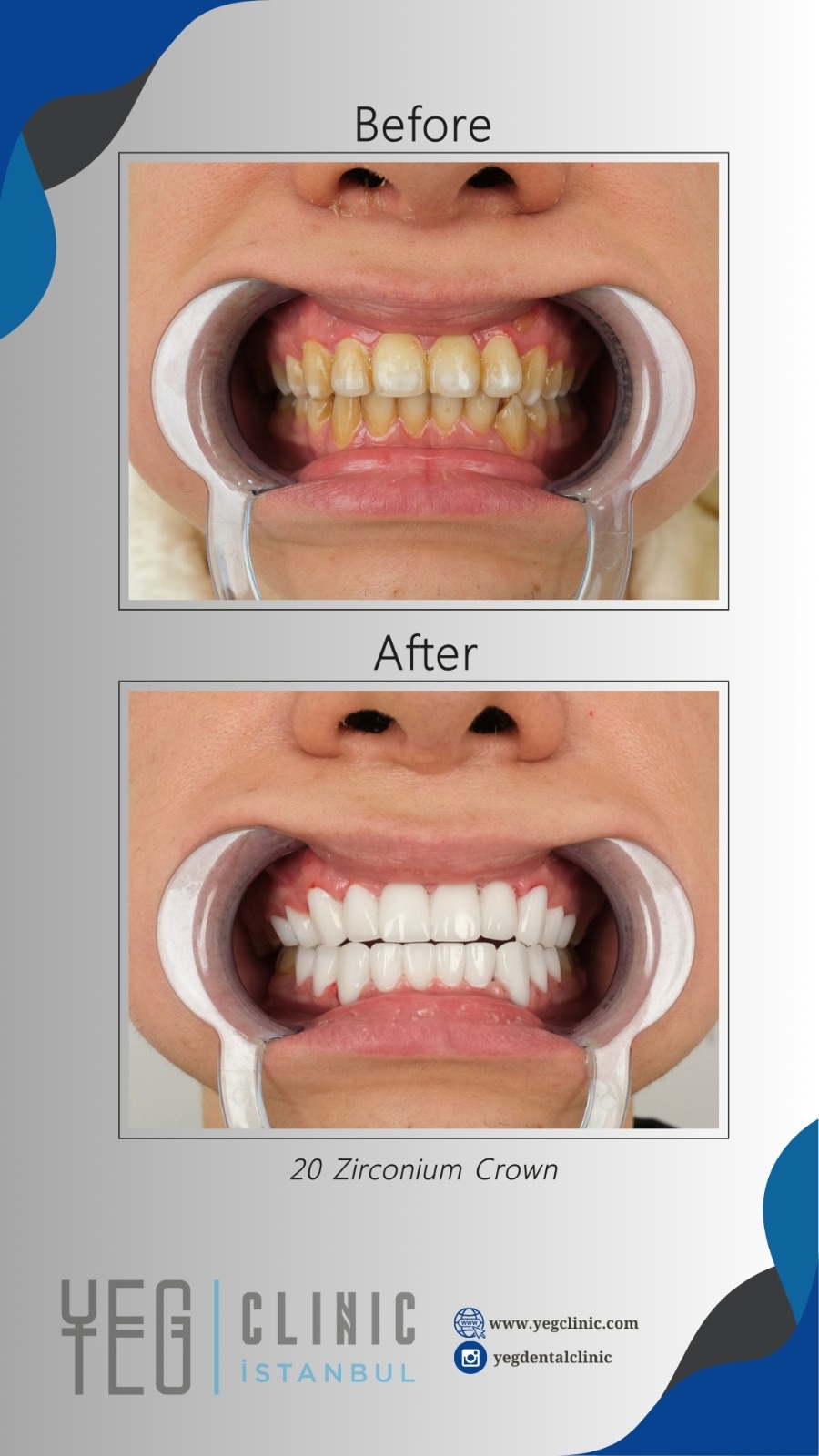 Couronnes Zircones — Yeg clinic