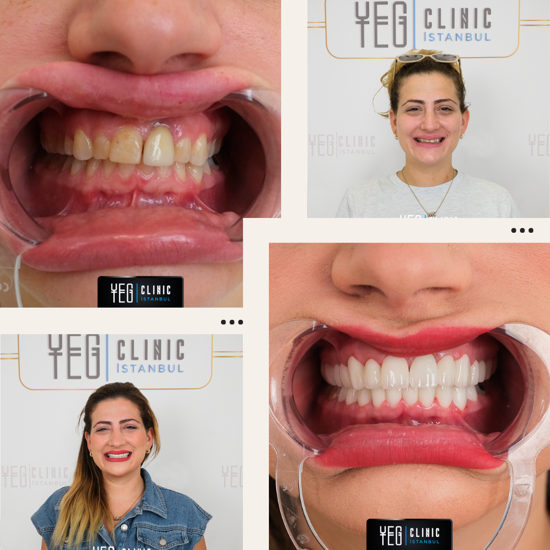 Couronnes Zircones — Yeg clinic