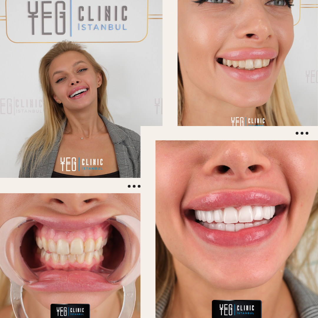 Facettes Emax — Yeg clinic