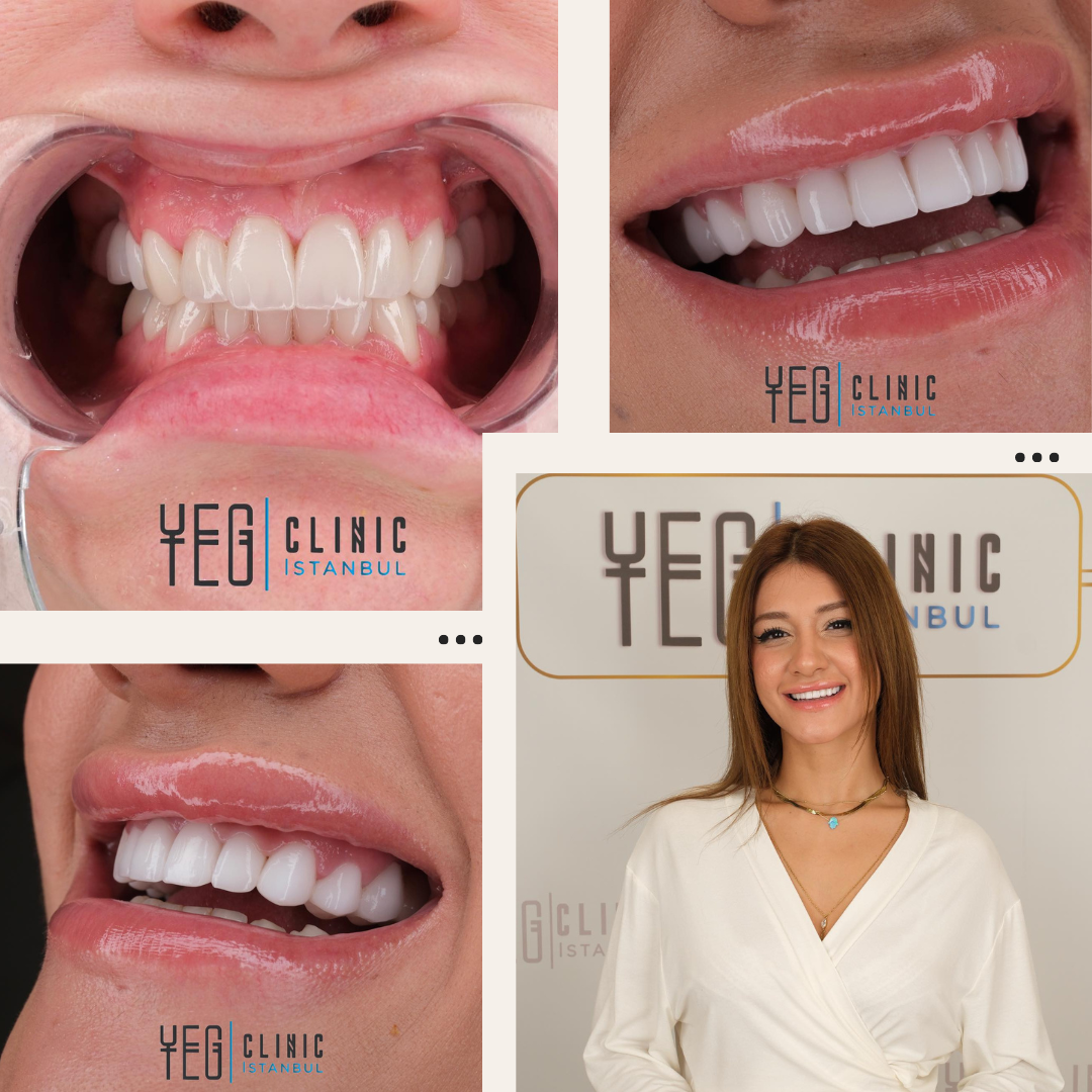 Facettes Dentaires — Yeg clinic