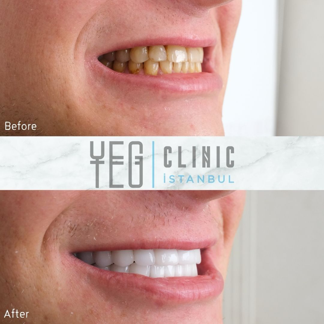 Facettes Dentaires — Yeg clinic