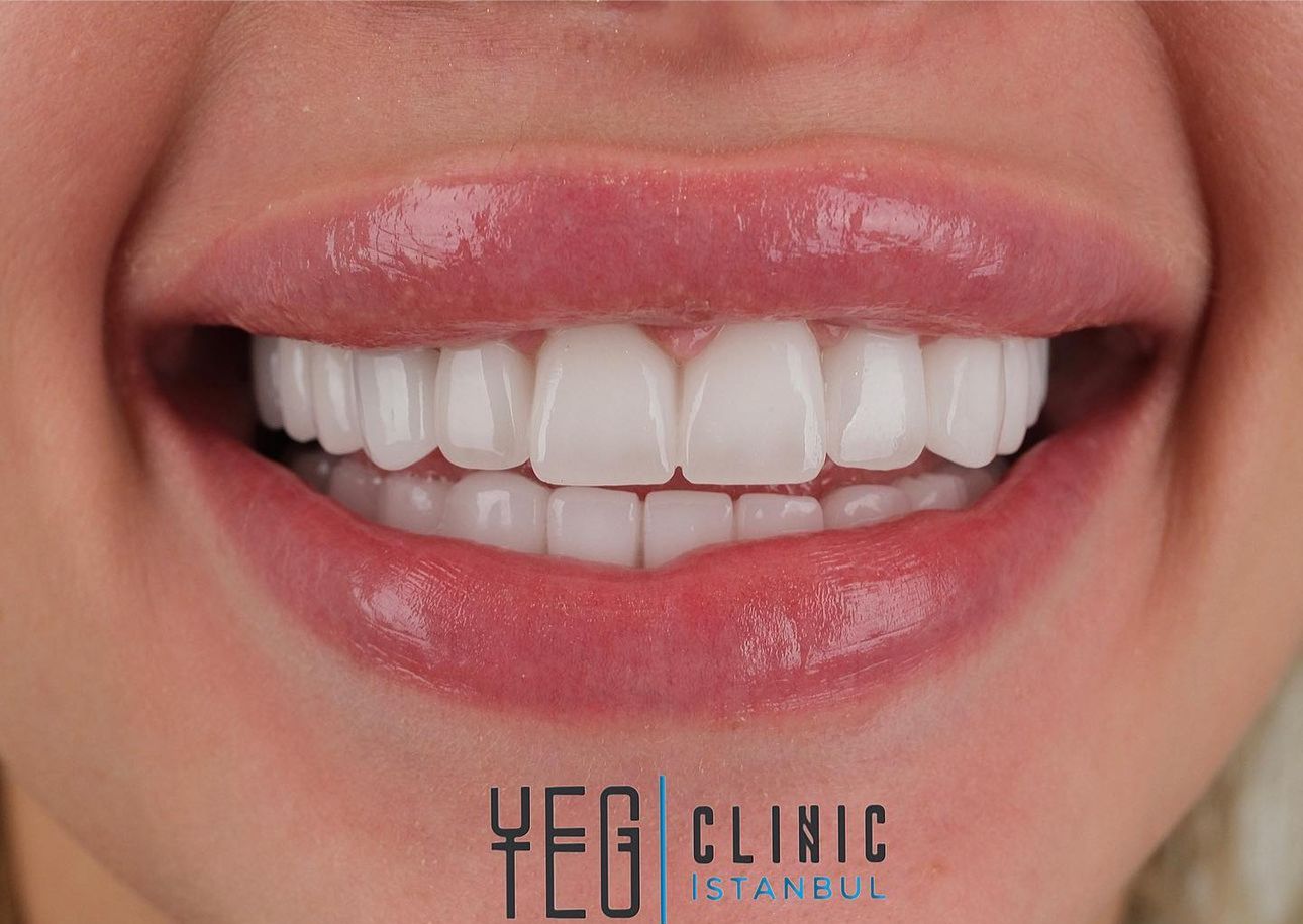 Facettes Dentaires — Yeg clinic