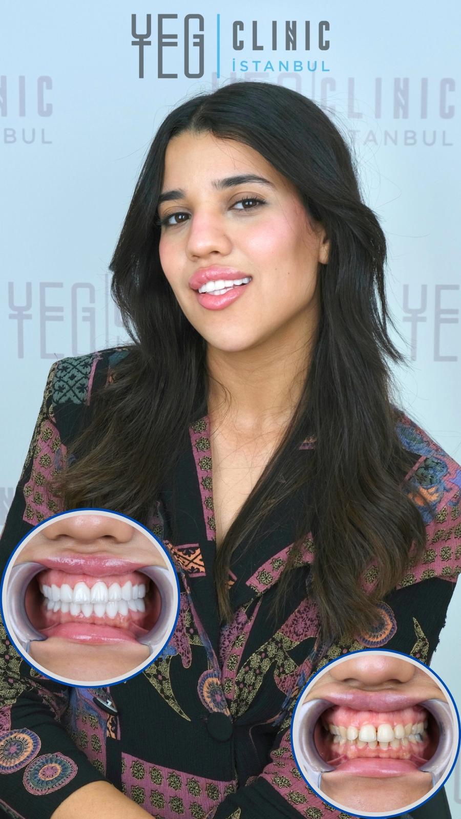 Hollywood Smile — Yeg clinic