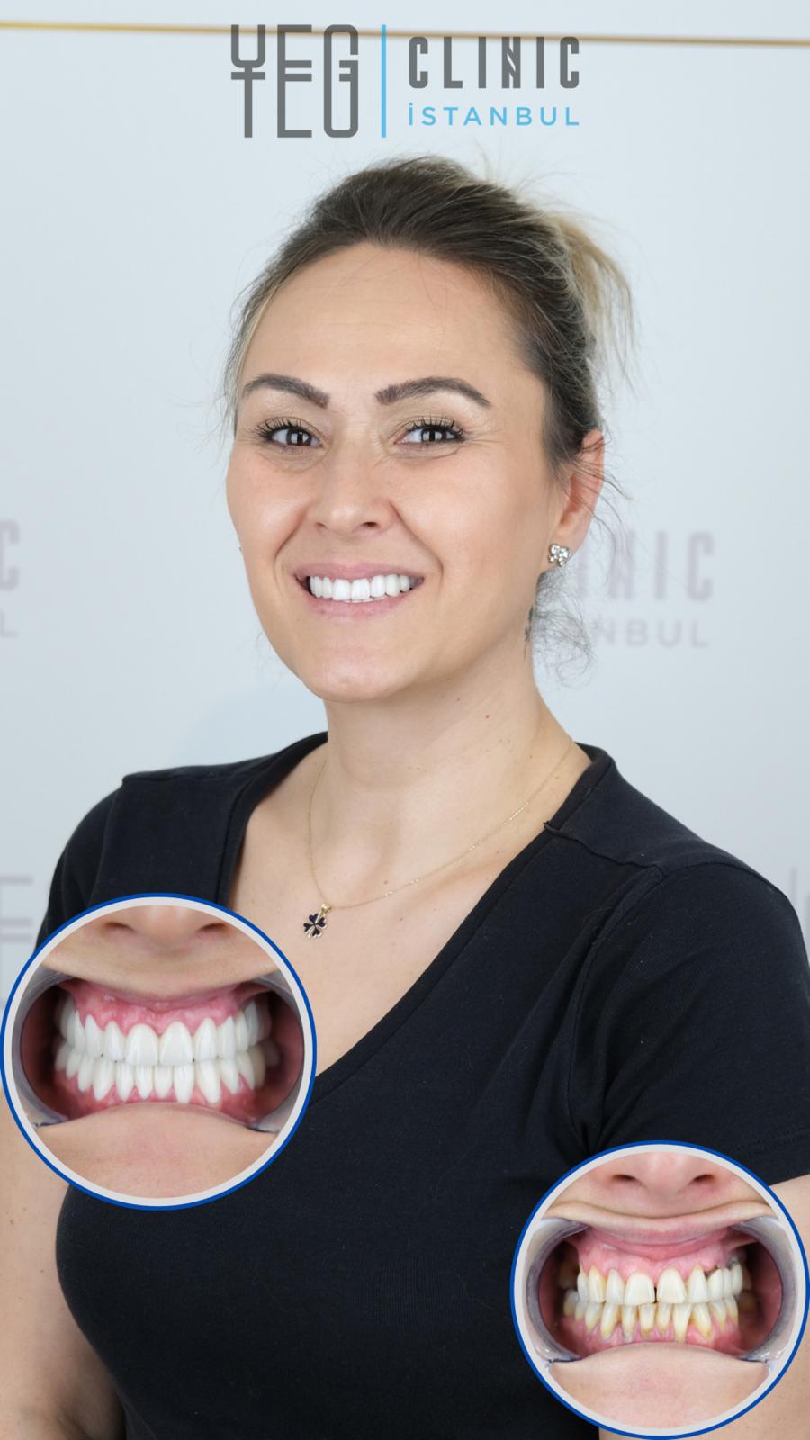 Hollywood Smile — Yeg clinic