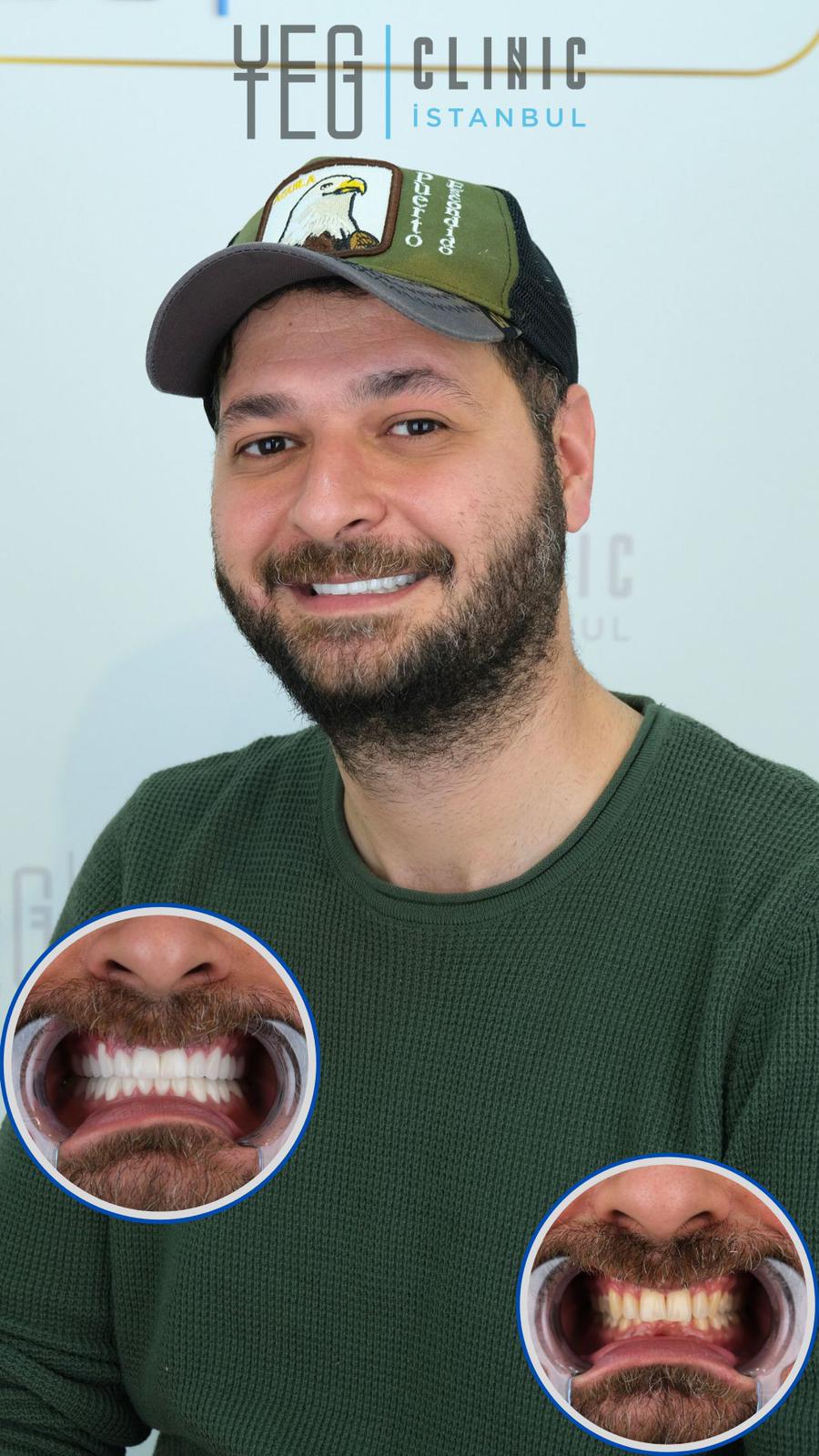 Hollywood Smile — Yeg clinic