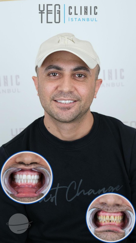 Hollywood Smile