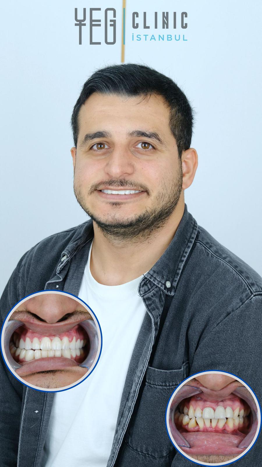 Hollywood Smile — Yeg clinic