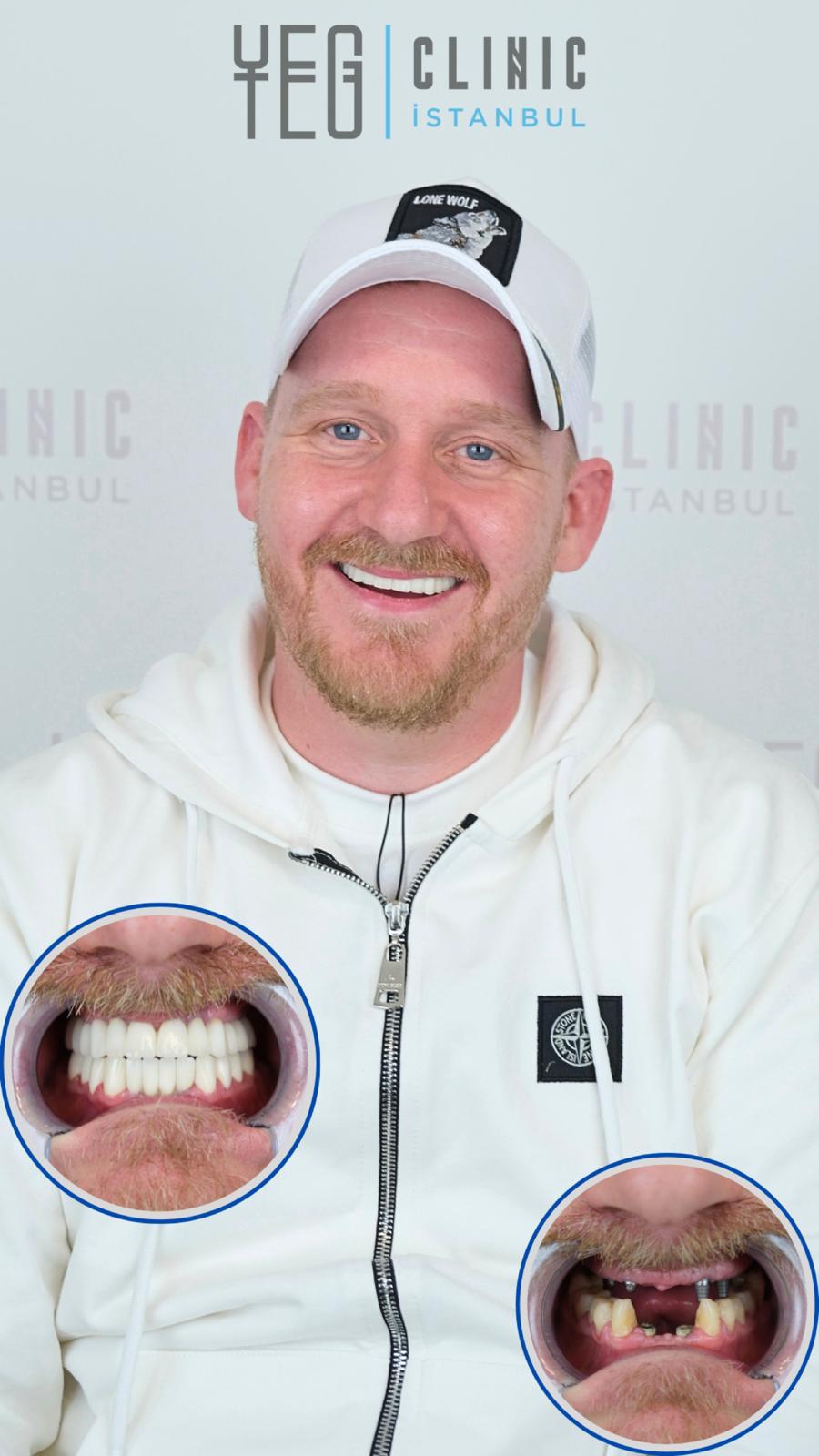 Implants Dentaires — Yeg clinic