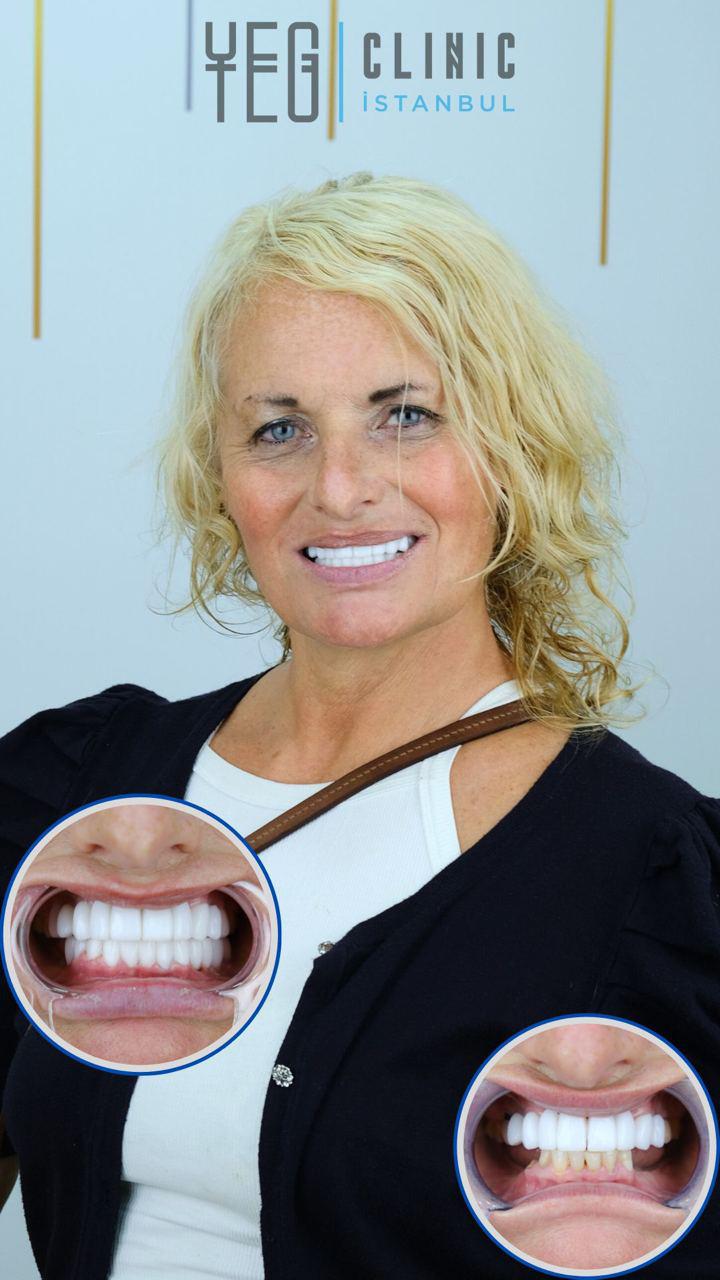 Implants Dentaires — Yeg clinic
