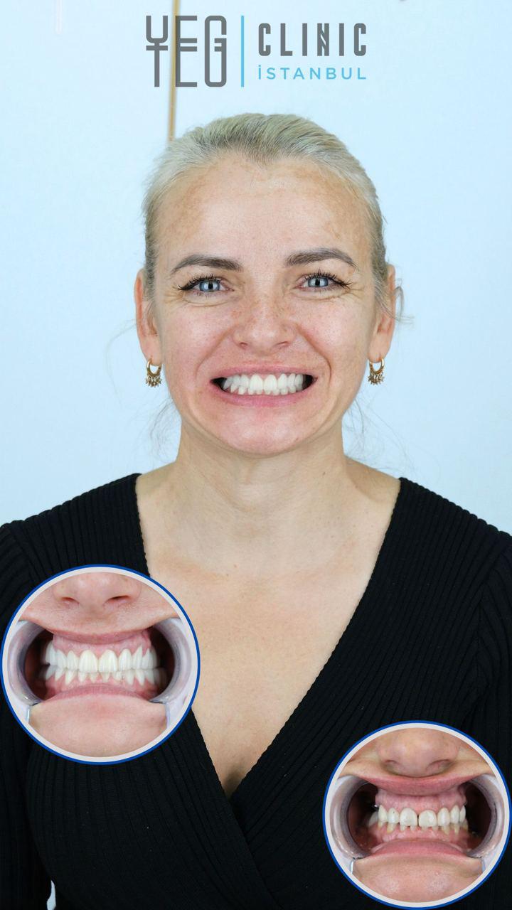 Implants Dentaires — Yeg clinic