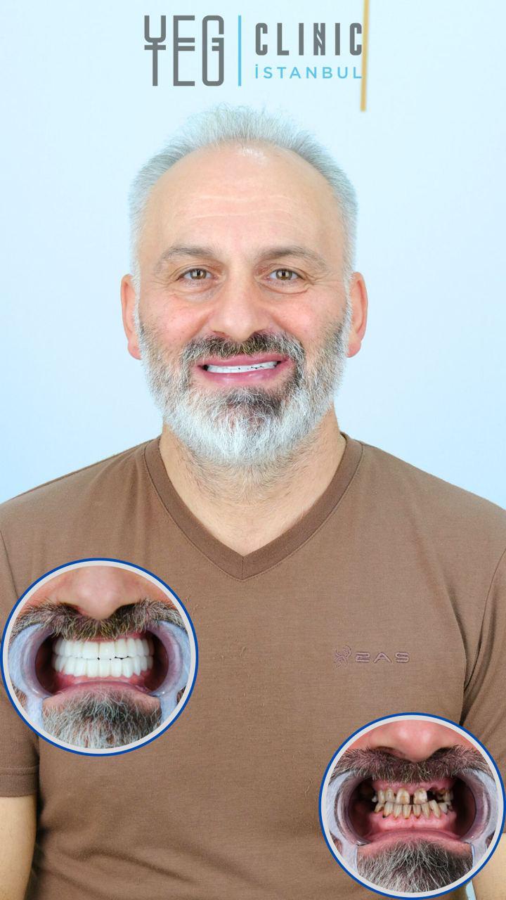 Implants Dentaires — Yeg clinic