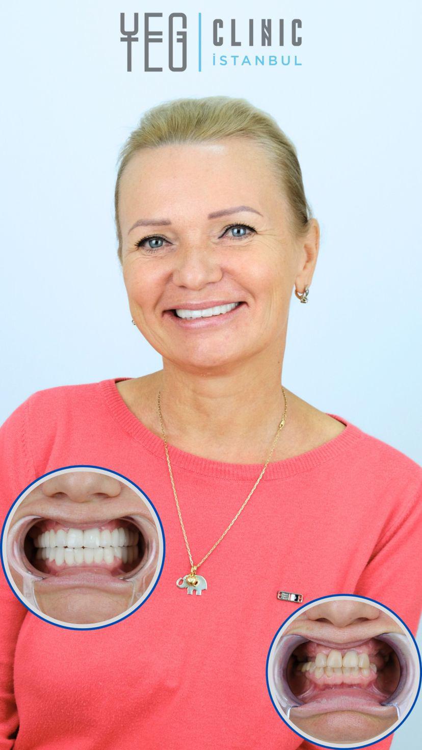 Implants Dentaires — Yeg clinic