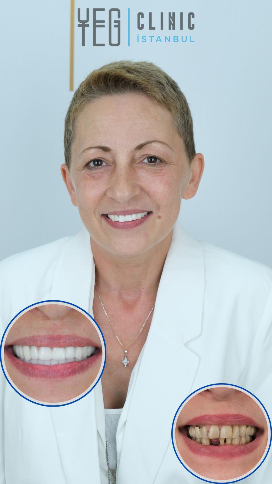 Implants Dentaires — Yeg clinic