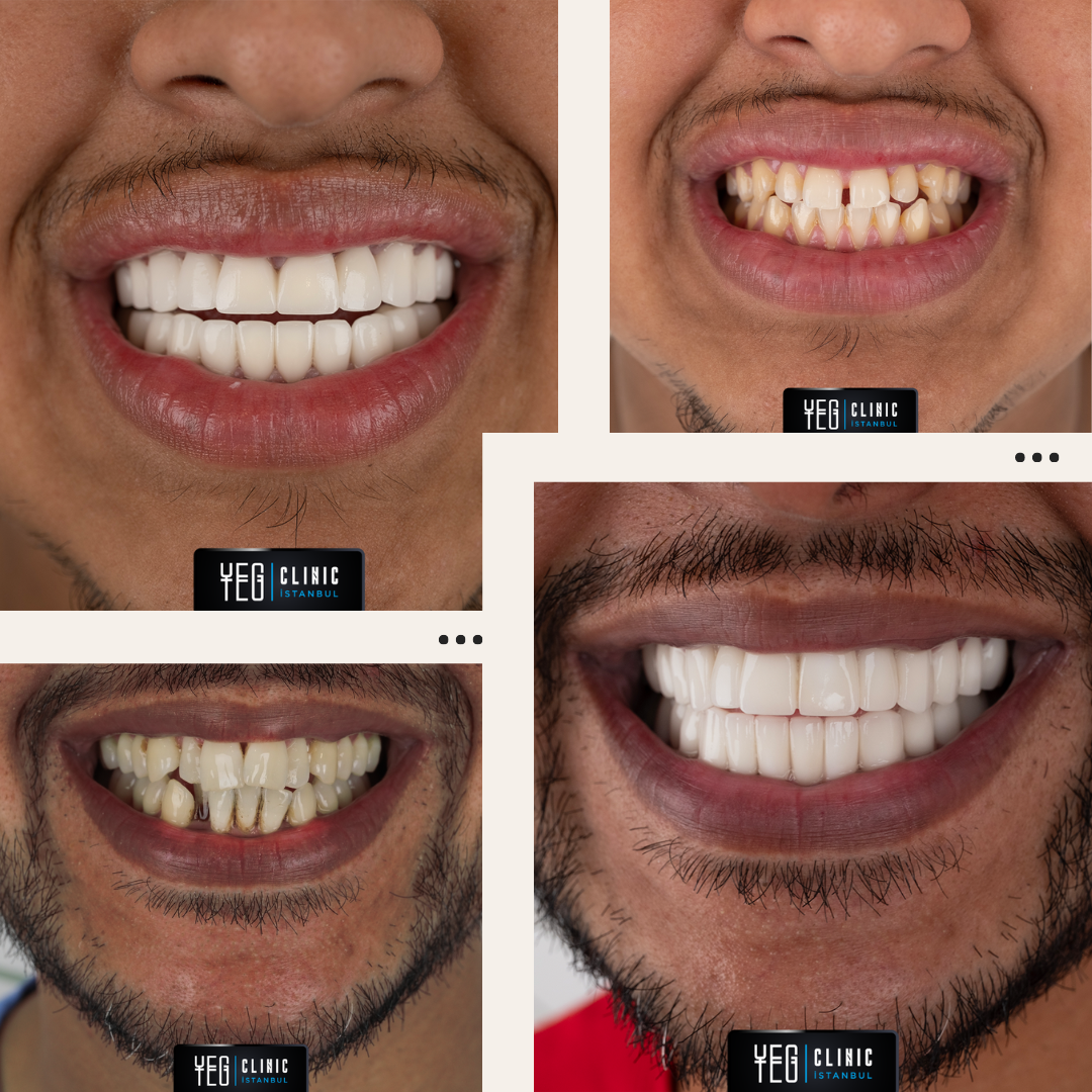 Implants Dentaires — Yeg clinic