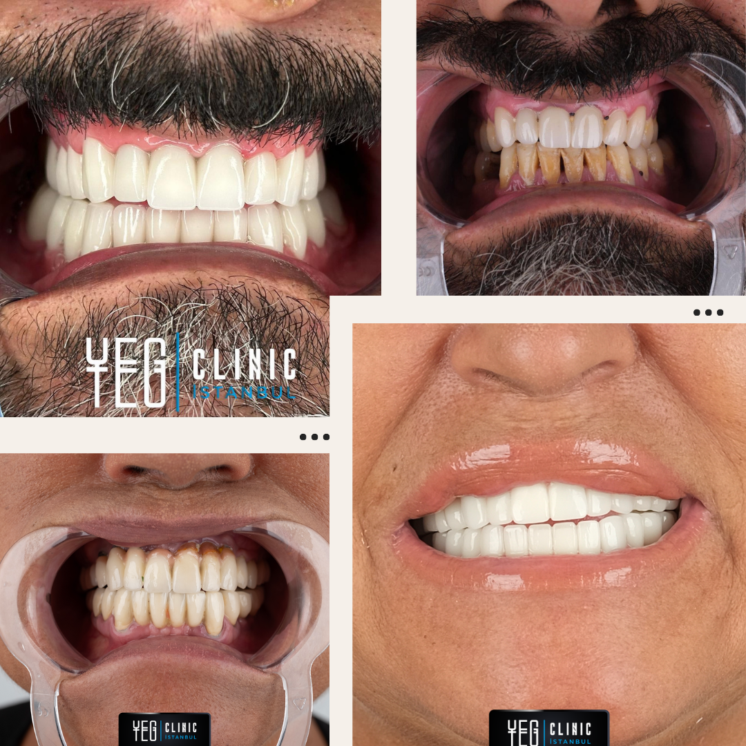 Implants Dentaires — Yeg clinic