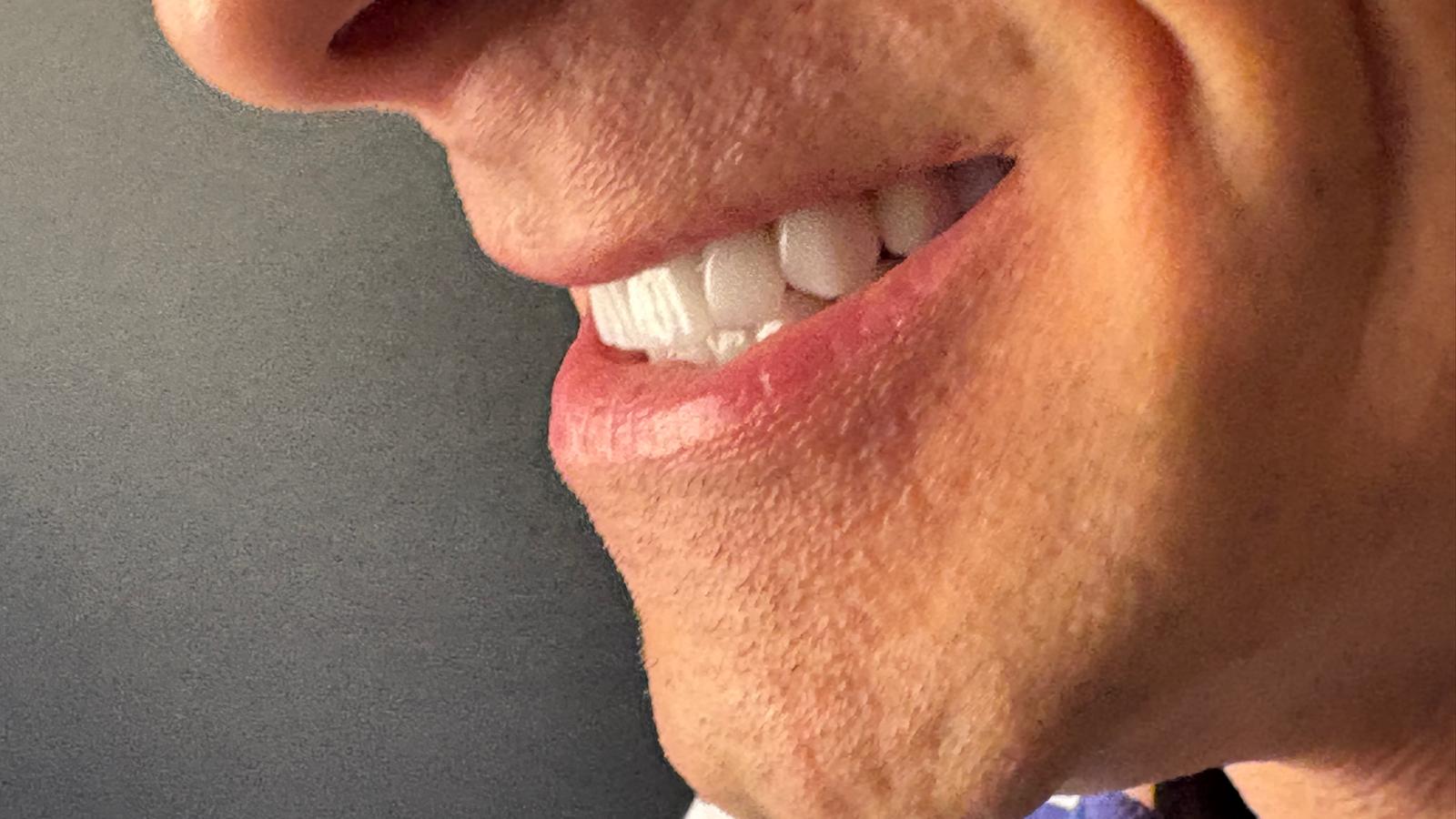 Couronnes Zircones — HealthPointWorld