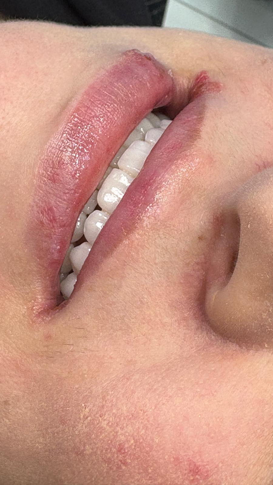 Couronnes Zircones — HealthPointWorld