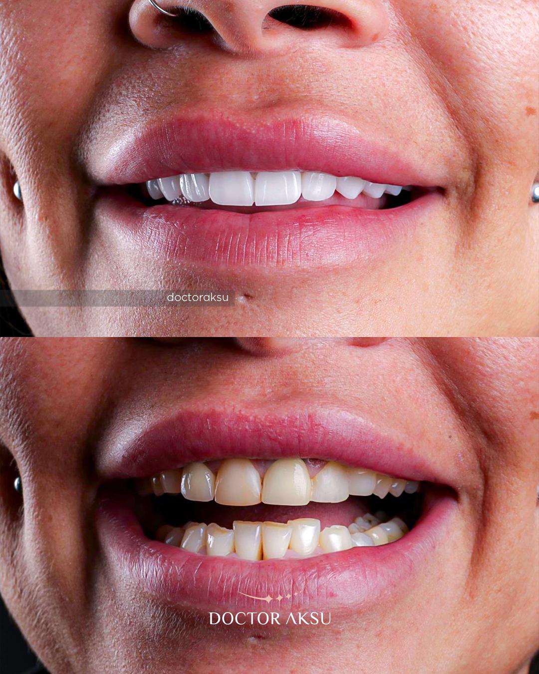 Hollywood Smile — HealthPointWorld