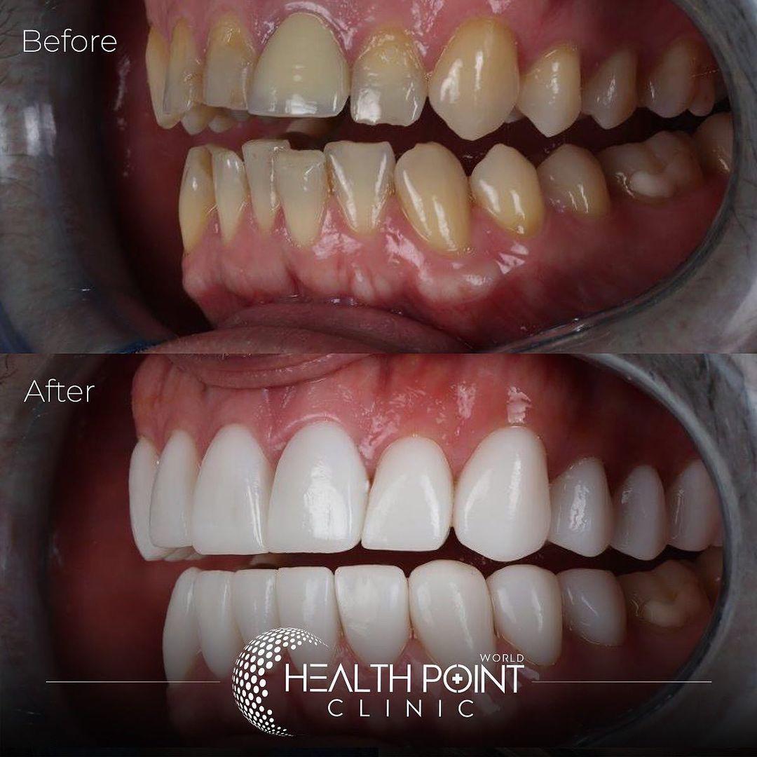Implants Dentaires — HealthPointWorld