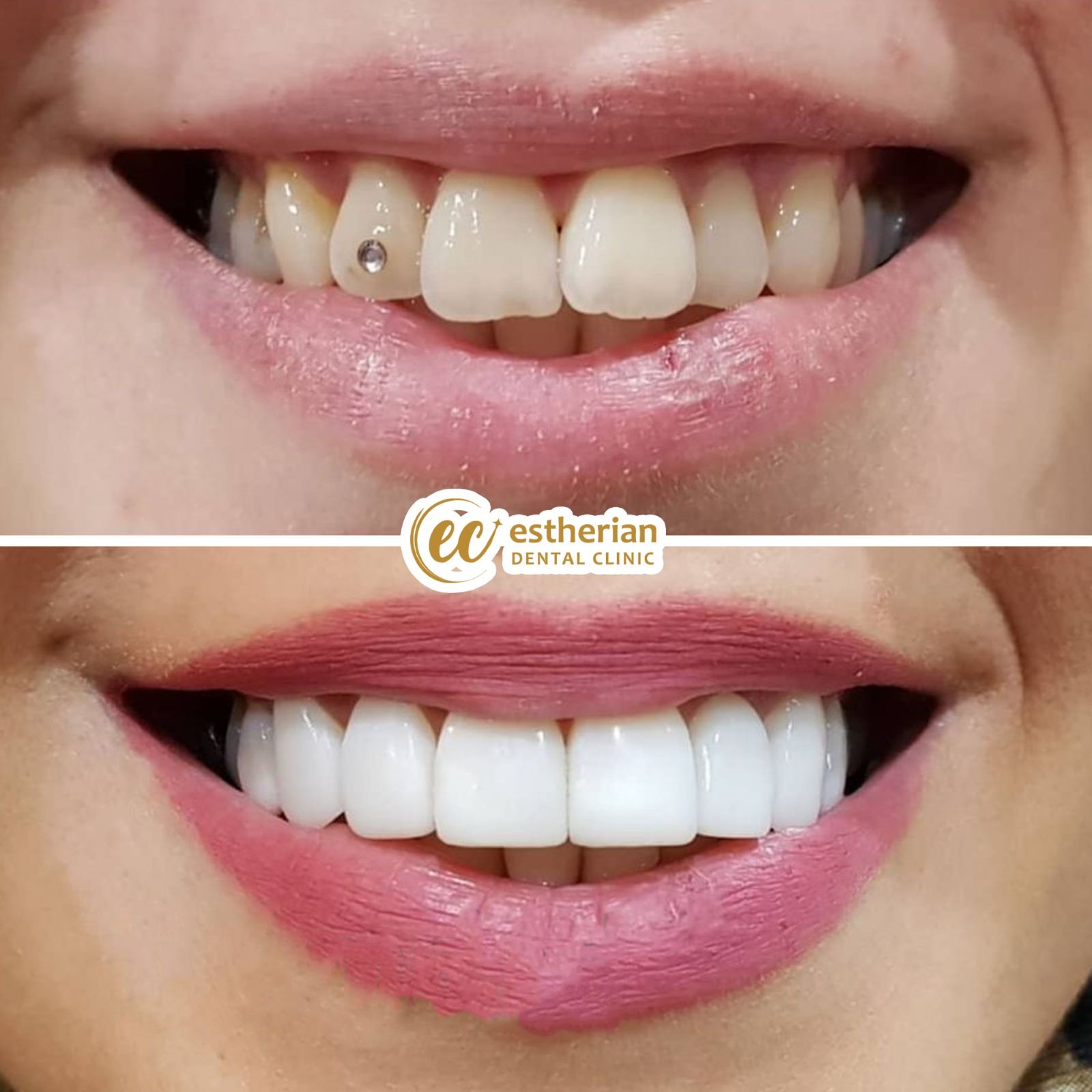 Couronnes Zircones — Estherian clinic