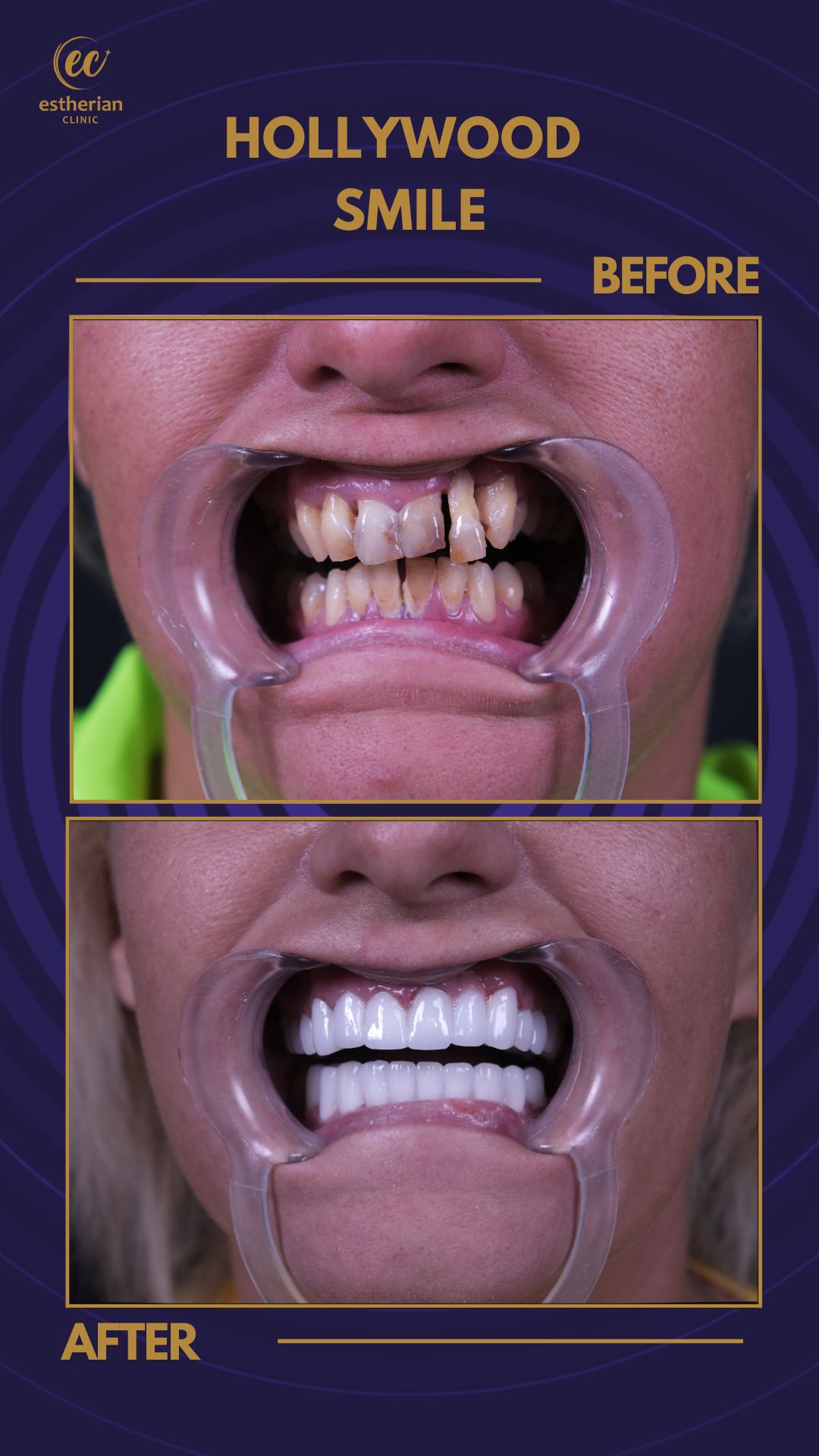 Couronnes Zircones — Estherian clinic