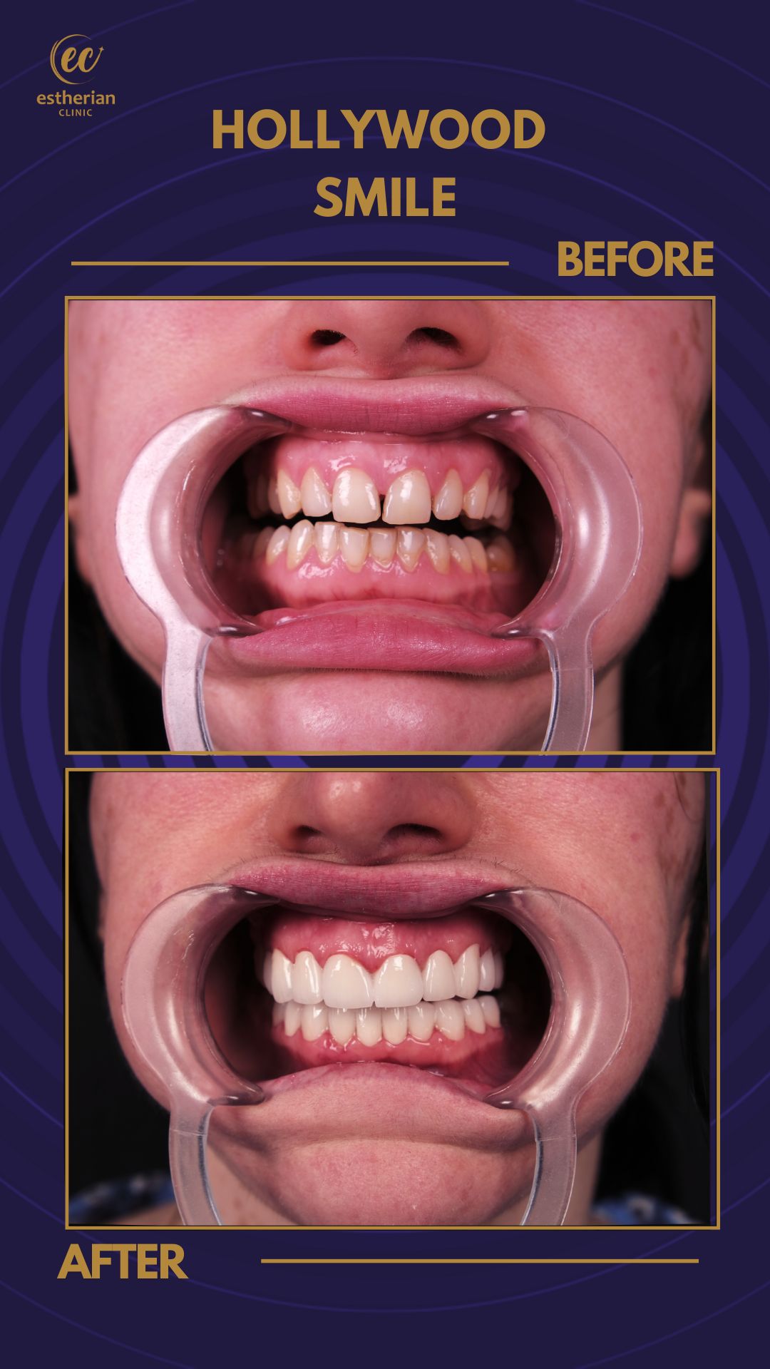 Couronnes Zircones — Estherian clinic