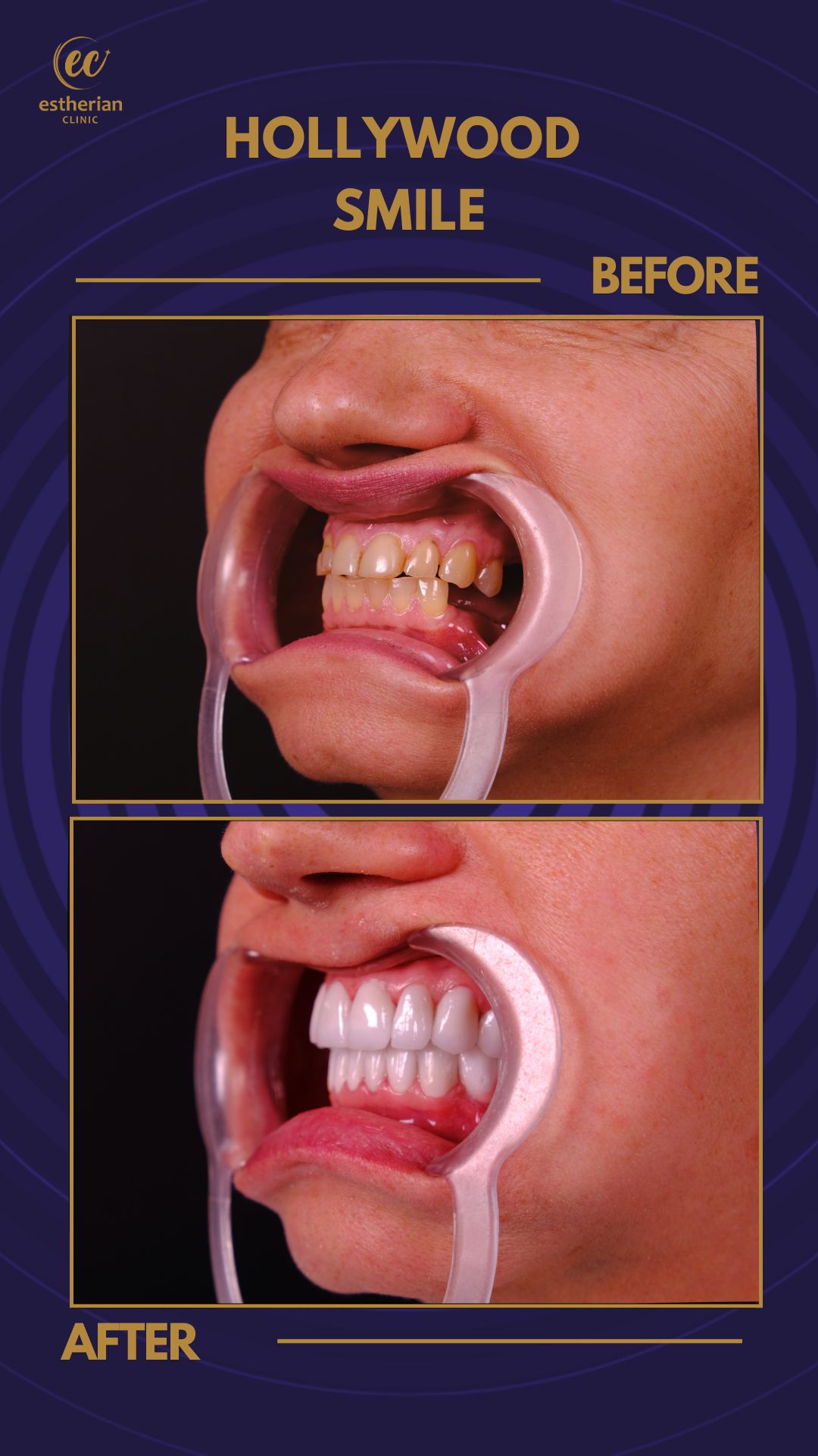 Couronnes Zircones — Estherian clinic