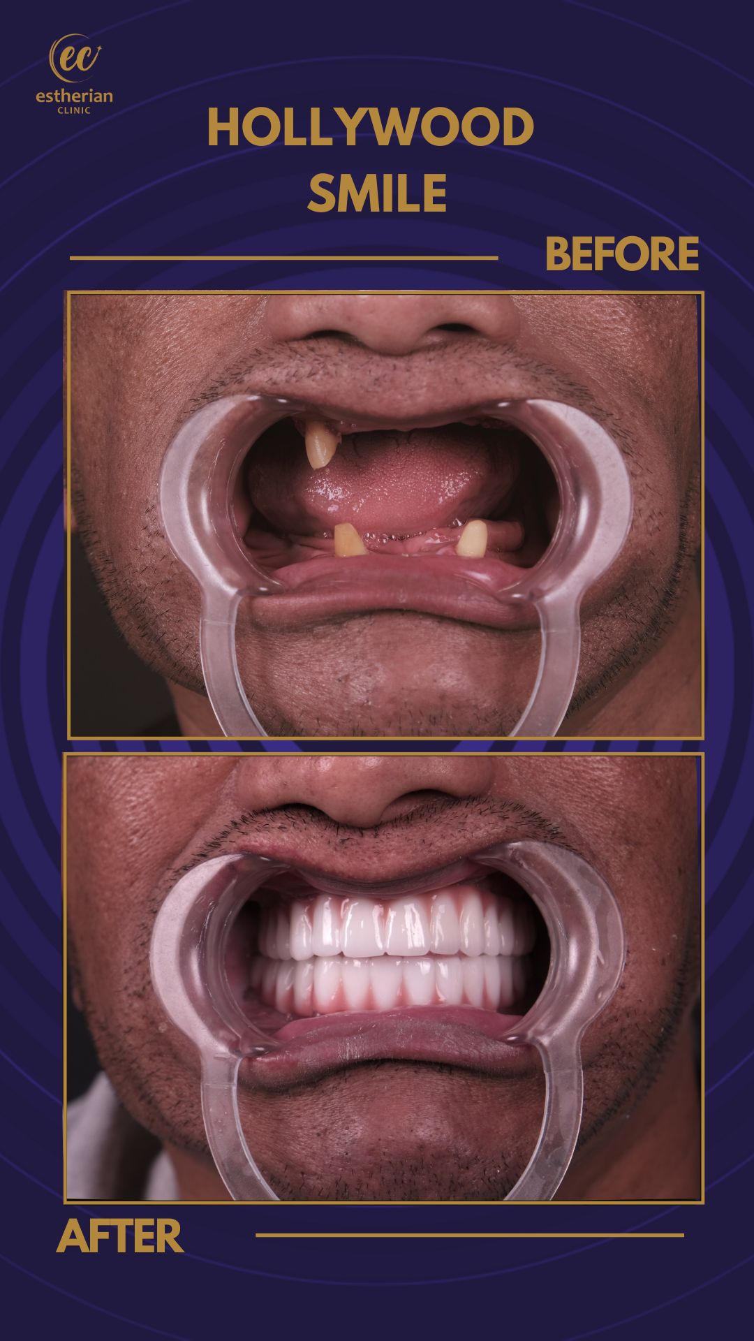Implants Dentaires — Estherian clinic