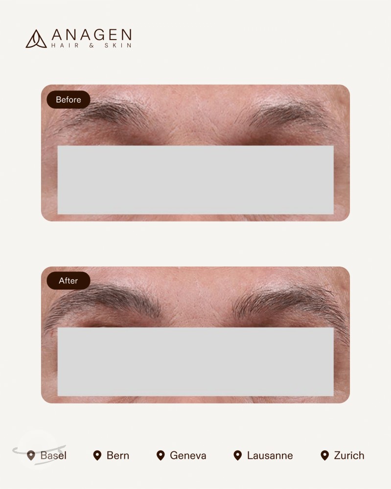 Before-After ET-1