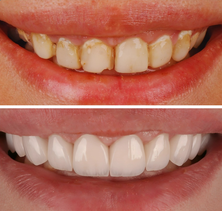 Facettes Dentaires — Aladin Dental Clinic
