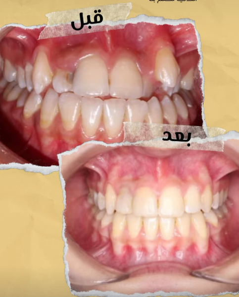 Invisalign — Aladin Dental Clinic