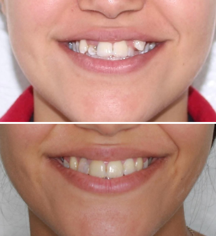 Invisalign — Aladin Dental Clinic