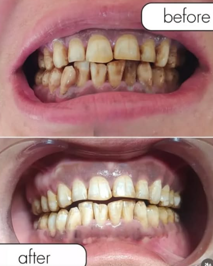 Blanchiment Dentaire — Aladin Dental Clinic